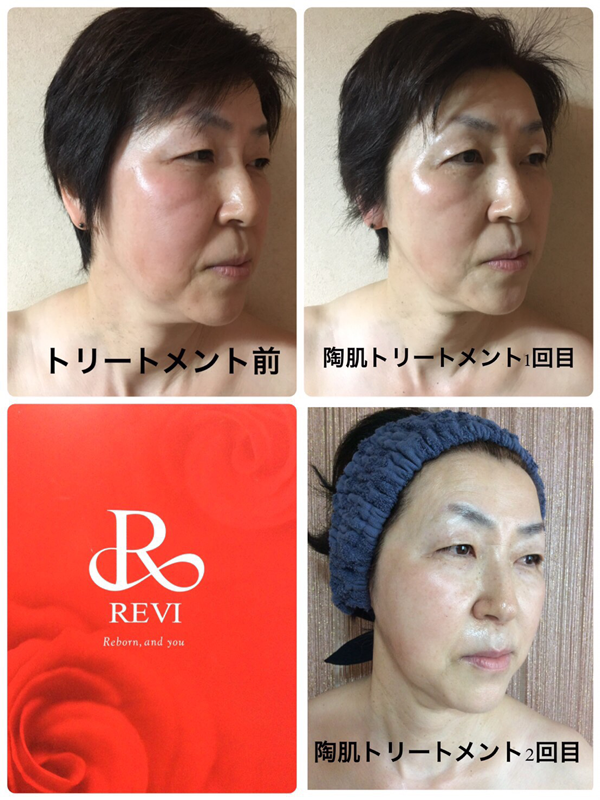 REVI 陶肌トリートメント（plusエンザイム）5回分プラスエンザイム追加